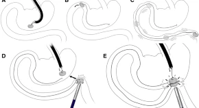 K. Hybrid fluorescent magnetic gastrojejunostomy: an experimental feasibility study in the porcine model and human cadaver